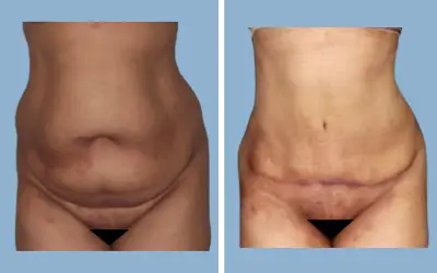 Before and After